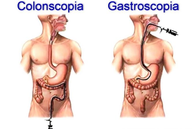 Colonoscopia Dr Costea Cristian