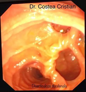 diverticuloza duodenala dr costea cristian